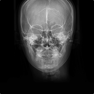 X-RAY